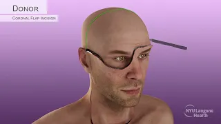 Aaron James's Partial-Face & Total-Eye Transplant Surgical Animation, 2023