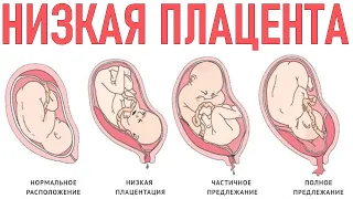 НИЗКАЯ ПЛАЦЕНТА ВО ВРЕМЯ БЕРЕМЕННОСТИ | Чем опасно низкое расположение плаценты