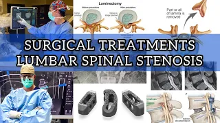 Surgical Treatment For Lumbar Spinal Stenosis (Part 2)