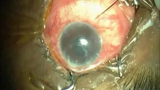 AC tap and Intravitreal Injection Technique in Endophthalmitis