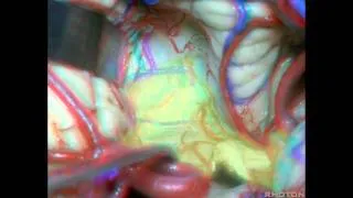 Cerebellopontine Angle and Fourth Ventricle (3D) - Part 2 of 2