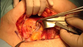 Maylard's incision: how to make an easy incision for complex pelvic abdominal surgery