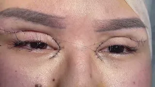 blefaroplastika. qovoqlar plastikasi