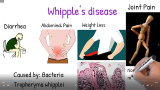 Whipple's disease made easy. Whipple disease symptoms, treatment prognosis