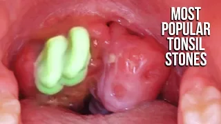 Most Popular Tonsil Stone Removals on YouTube!