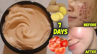 Remove dark spots, pigmentation and acne scars in 7 days | 7 Days Skin Transformation