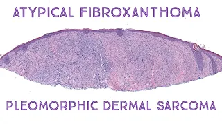 Atypical Fibroxanthoma & Pleomorphic Dermal Sarcoma (Oregon case 2)