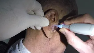 Old Man's Dry Earwax Removal and Ear Cleaning