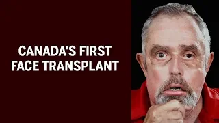 The story behind Canada's first face transplant