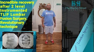 Incredible recovery after 2 level Instrumented TLIF Lumbar Fusion Surgery. Revolutionary technique