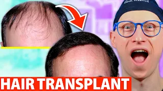 6 Most Asked Hair Transplant Questions