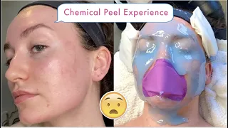 Chemical Peel Facial Vlog | Before & After
