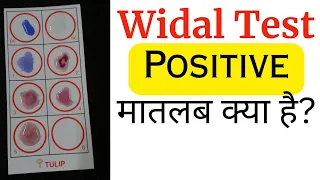 Widal test Hindi | widal test kya hota hai? | Widal test positive meaning?