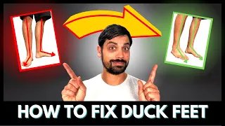 The HIDDEN Cause For Your Duck Feet & How To Fix It FAST