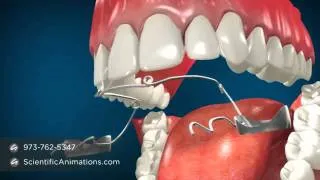 Jaw Surgery for Teeth Alignment - Fixing Jaw Braces