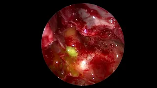 Sphenoid sinus CSF leak - Intrathecal fluorescein