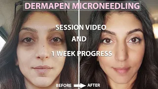 Dermapen Microneedling Before And After | Process + 1 Week Amazing Results