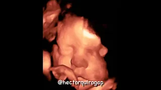 3D Ultrasound Scan of a Baby Boy at 31 Weeks