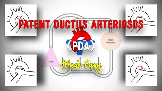PDA • Patent Ductus Arteriosus • Anatomy • Pathophysiology • Clinical features • Made Easy