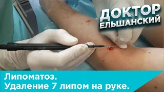 Липоматоз. Удаление 7 липом на руке.