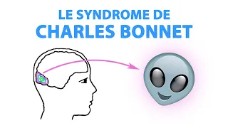 Le syndrome de Charles BONNET atteint les personnes malvoyantes