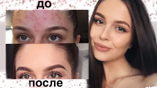 КАК ИЗБАВИТЬСЯ ОТ ПРЫЩЕЙ ?! МОЯ ИСТОРИЯ