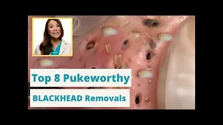 Dr  Pimple Poppers 8 WORST Blackhead Removals   You're not going to want to eat while you watch this