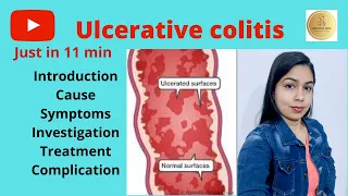 Ulcerative colitis in Hindi- cause, symptoms, treatment, complication ||Learn with Dr. Shipra||