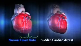 Sudden Cardiac Arrest (SCA)