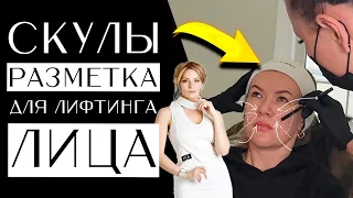 Скулы - Разметка для лифтинга лица