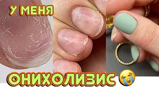 У меня ОНИХОЛИЗИС 😱 Муж испортил ногти? / Маникюр на правой руке