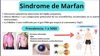 Sindrome de Marfan // Tratamiento y Caso clinico del sindrome de Marfan