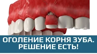 Пластика десны. Лоскутная операция при рецессии десны.