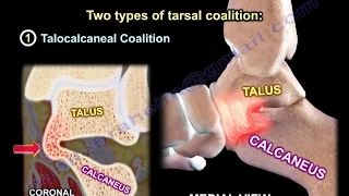 Tarsal Coalition - Everything You Need To Know - Dr. Nabil Ebraheim