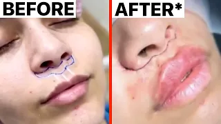 @DoctorYoun Lip Lift: Why It's a No No! | Nurse Reacts