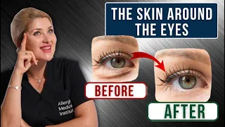 How to get rid of wrinkles under the eyes? Dark circles under eyes