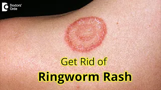 7 GREAT Tips for Prevention & Treatment of RINGWORM RASH- Dr. Amrita Hongal Gejje | Doctors' Circle