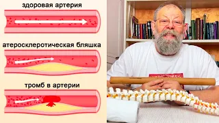 Революционный метод определения атеросклероза без медицинских тестов - открывает Виктор Владиленович