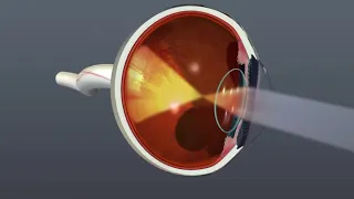 (Audio Description) Animation: Diabetic Retinopathy