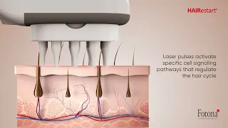 HAIRestart® - Non-Invasive Laser Stimulation of Hair Growth