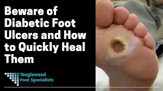 Beware of Diabetic Foot Ulcers and How to Quickly Heal Them