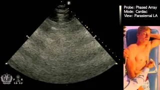 Parasternal Long Axis View - STEP by STEP Point of Care Ultrasound