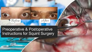 Preoperative & Postoperative Instructions for Squint Surgery | Squint Surgery | Vision Eye Centre