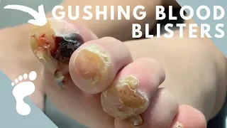 Nasty Festering Blood Blisters