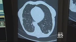 Doctors Puzzled By Increase In Lung Cancer Among Women Who Have Never Smoked