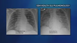 SSM Health Medical Minute: No lasting lung damage after recovery from COVID-19