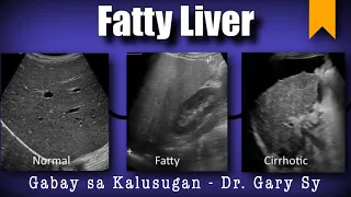 Fatty Liver - Dr. Gary Sy
