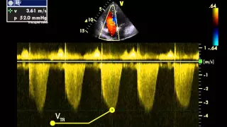 14. Estimating right ventricular / pulmonary artery systolic pressure from TR jet