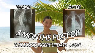 SCOLIOSIS SURGERY 3 MONTHS POST OP RECOVERY UPDATE! 🤍