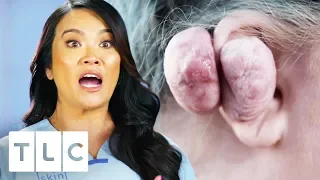 Dr. Lee Removes 14 Oz Keloid From Woman's Ear | Dr. Pimple Popper